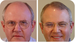 Hair Transplant Seattle Before and After Images