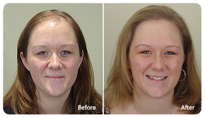 Hair Transplant Seattle Female Gallery