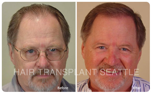 Hair Transplant Seattle Patient J.D. Franzen