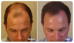 Hair Transplant Seattle Male Transplant Gallery