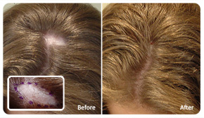 Hair Transplant Seattle Scar and Scalp Repair Gallery
